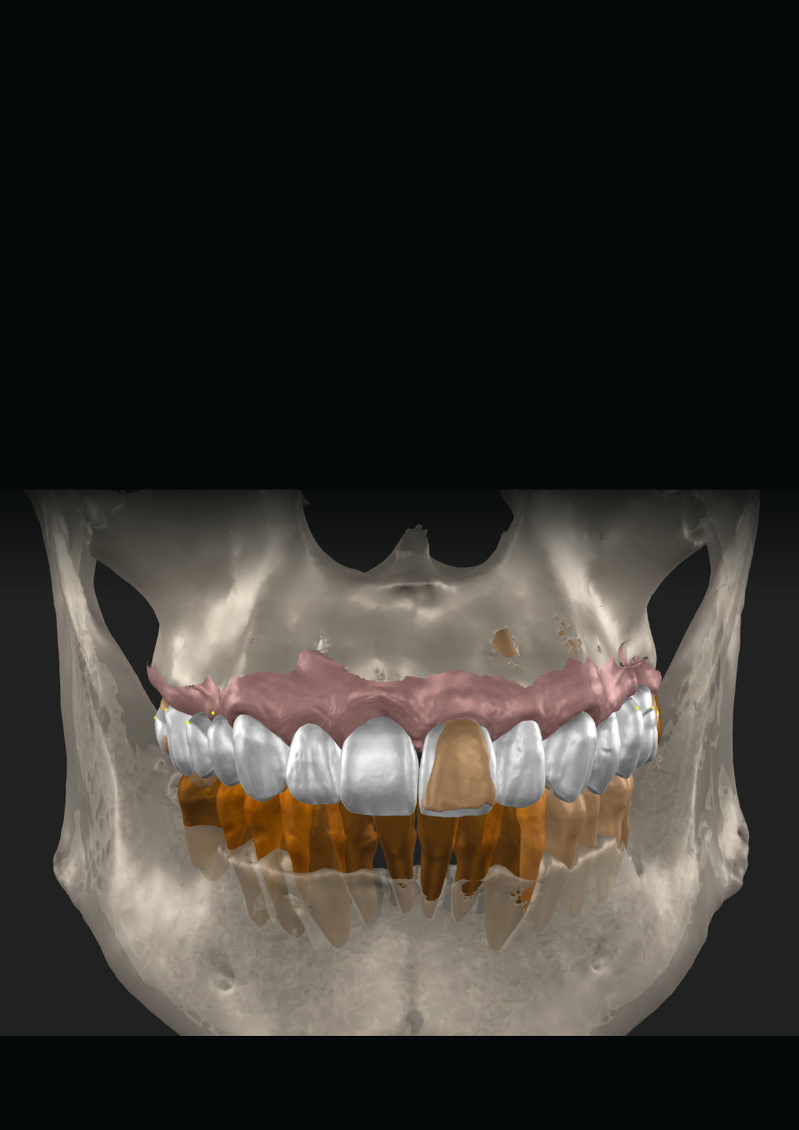Planeación digital de rehabilitación dental